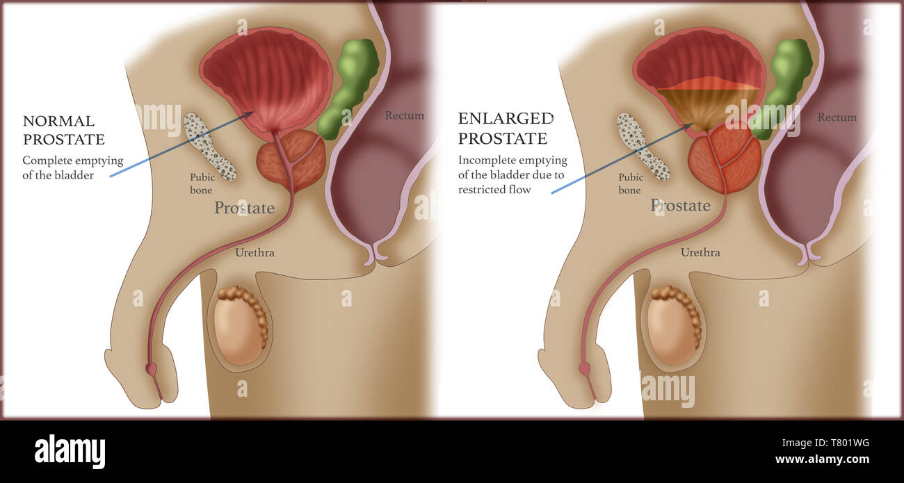 Confronto tra normale e ingrossamento della prostata Foto Stock