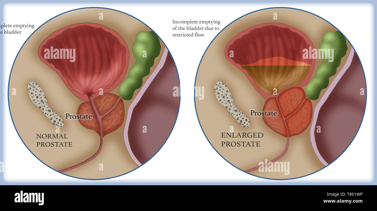 Confronto tra normale e ingrossamento della prostata Foto Stock