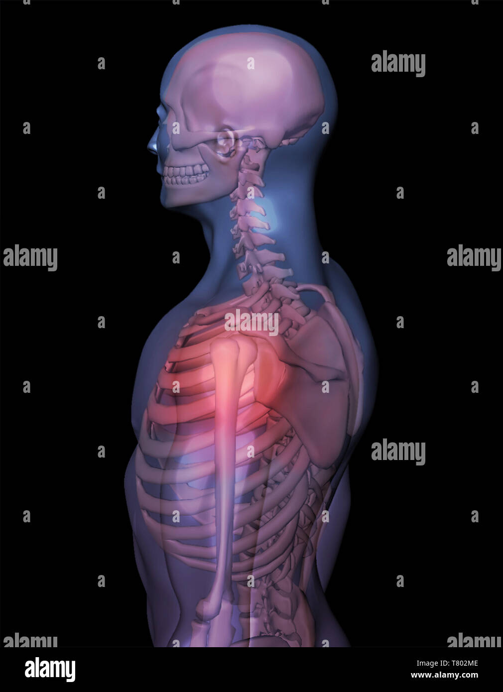 Dolore alla spalla, illustrazione Foto Stock