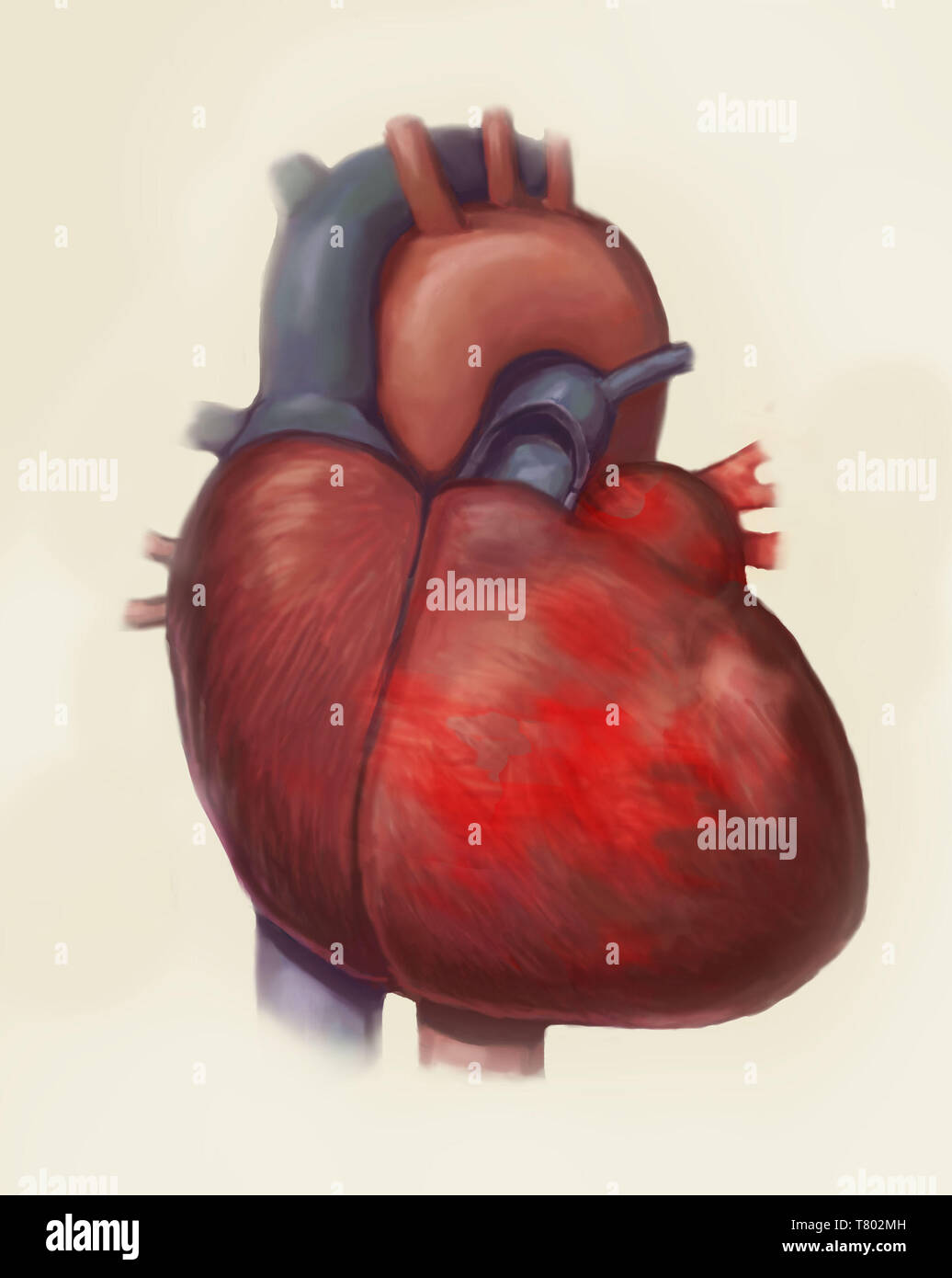 Insufficienza cardiaca, illustrazione Foto Stock