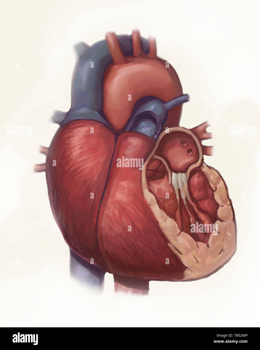 La malattia di cuore, illustrazione Foto Stock