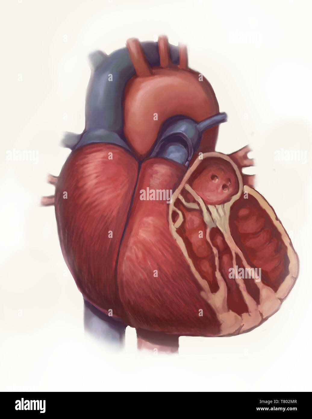 La malattia di cuore, illustrazione Foto Stock