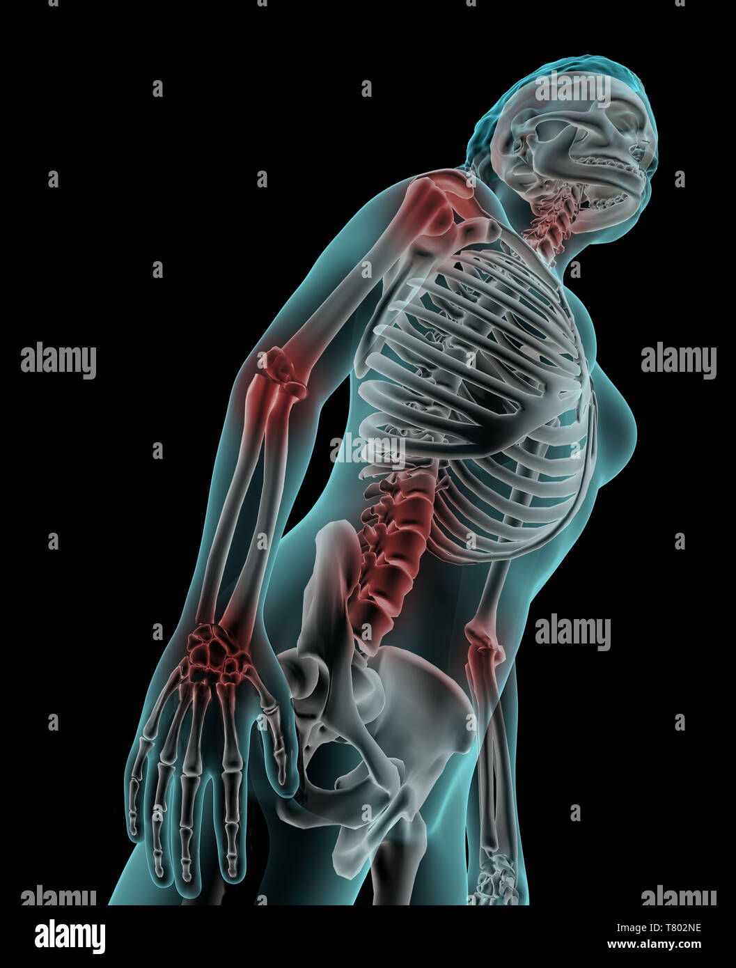 Artrite, illustrazione Foto Stock