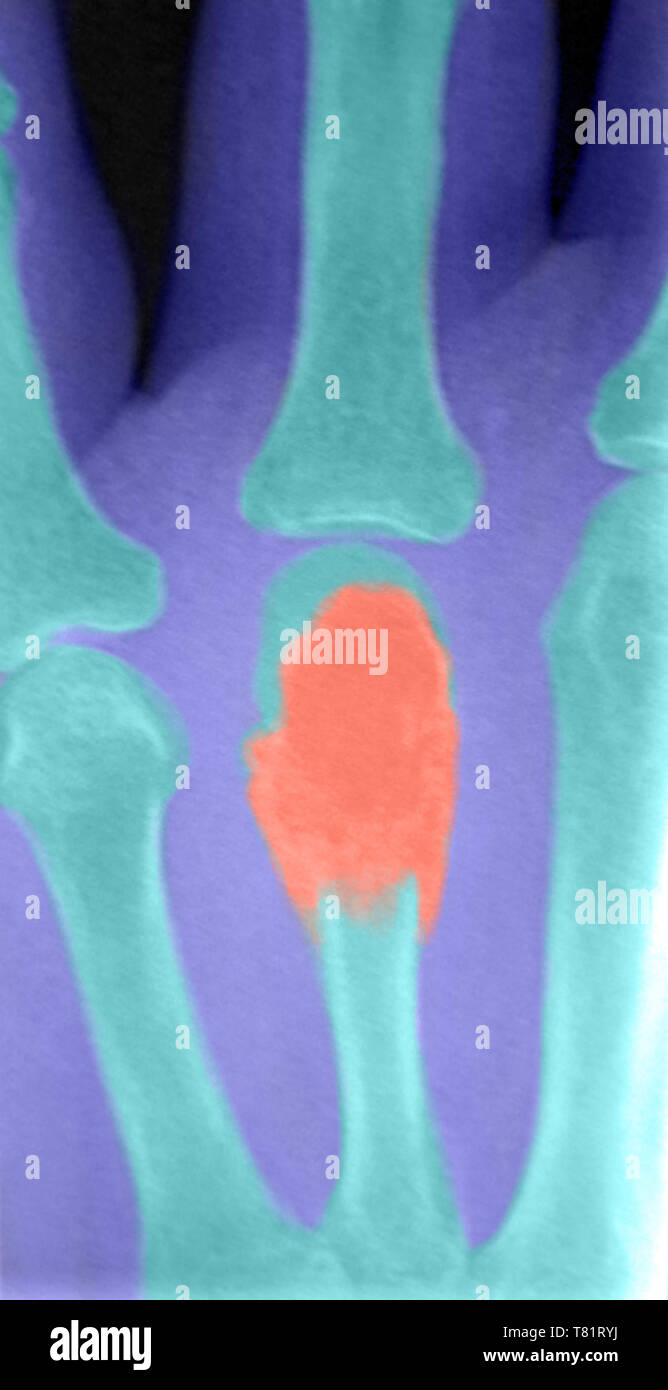 Cella gigante tumore osseo in mano, raggi X Foto Stock