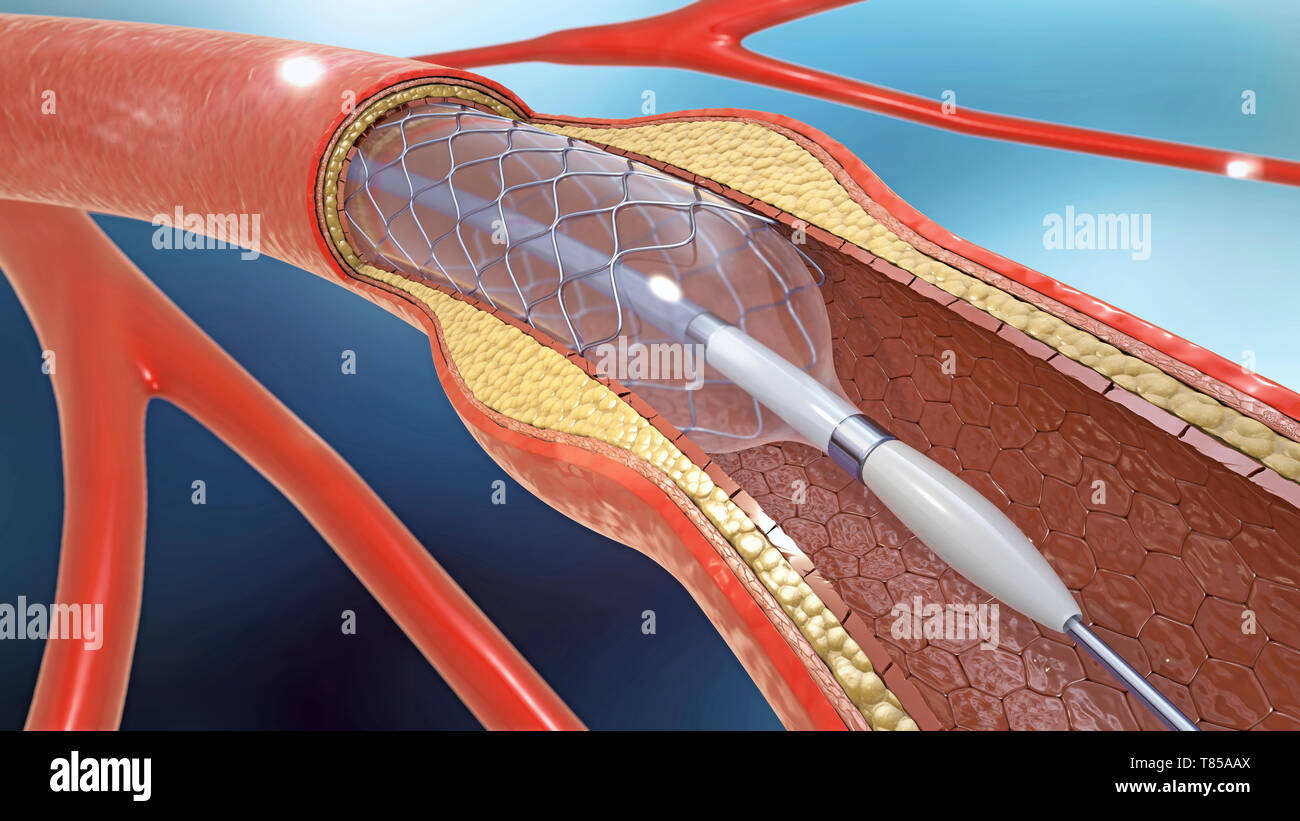 Stent arteriosi, illustrazione Foto Stock