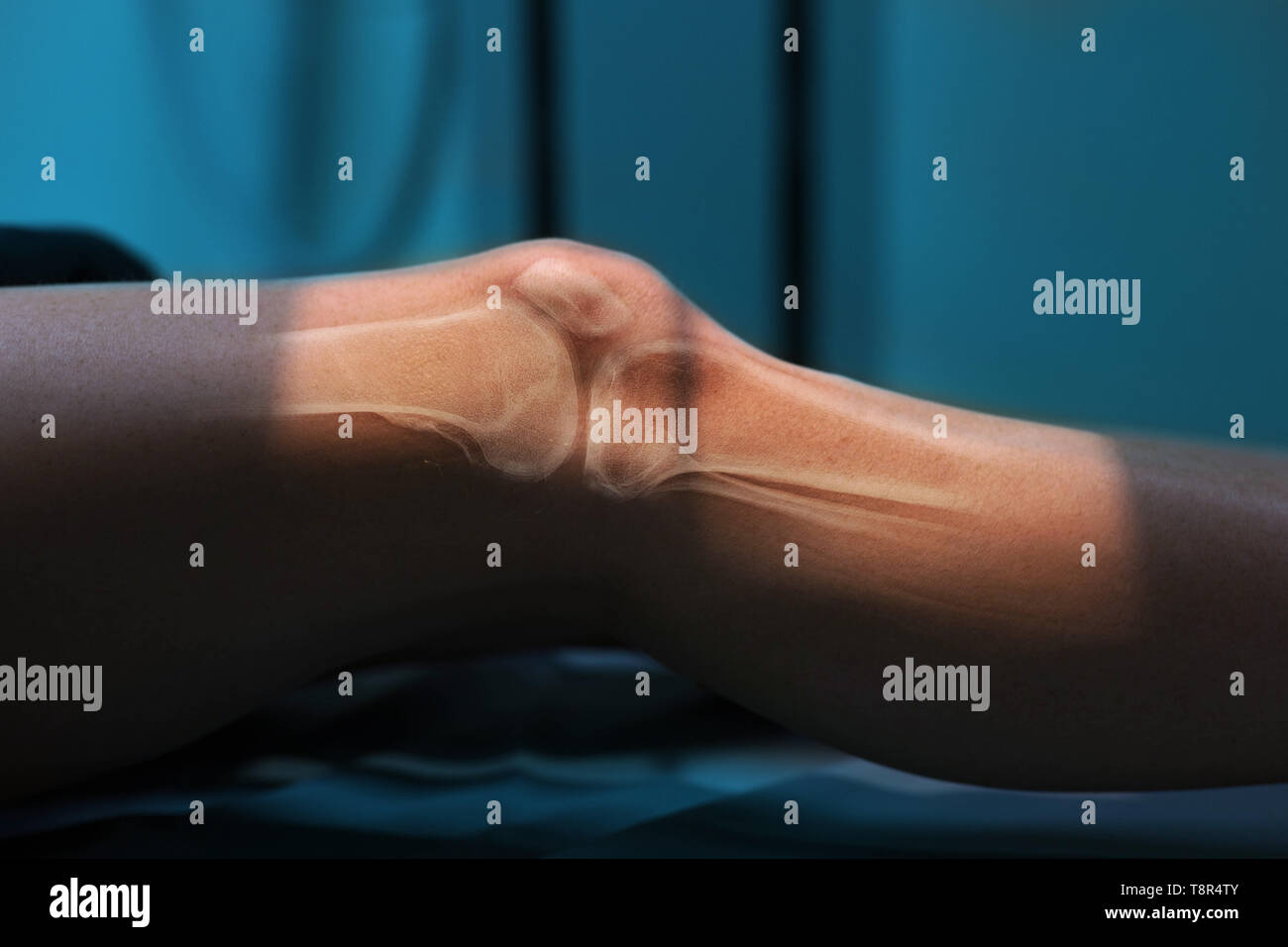 Colpo di processo x-ray, ginocchio close-up. Il disegno delle ossa e rotula Foto Stock