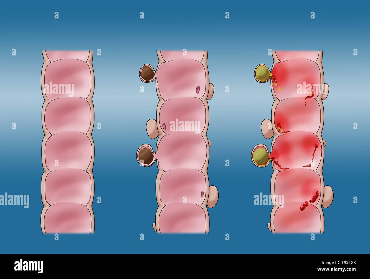 Illustrazione confrontando la diverticolosi (centrale) e diverticolite (a destra). Un sano colon è mostrato sulla sinistra. Foto Stock