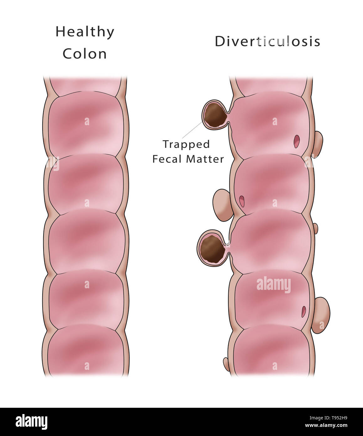 Illustrazione confrontando la comparsa di un sano colon (a destra) per uno con la diverticolosi (a destra). Foto Stock