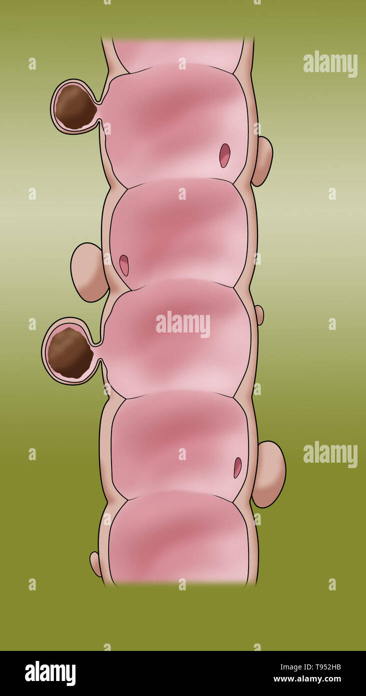 Illustrazione di un colon con la diverticolosi. Foto Stock
