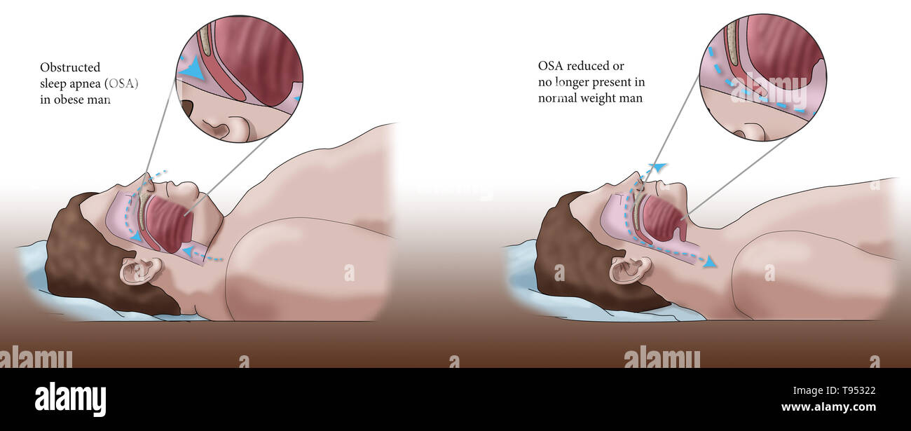 Una illustrazione di un confronto tra un obeso e traversina normale. Negli adulti, apnea nel sonno è comunemente causato da un eccesso di peso e l'obesità. Durante il sonno, quando la gola e la lingua i muscoli sono più rilassati, tessuti molli, eccesso di depositi di grasso e il peso di grasso addominale premendo sui polmoni possono interferire con il normale sonno. Foto Stock