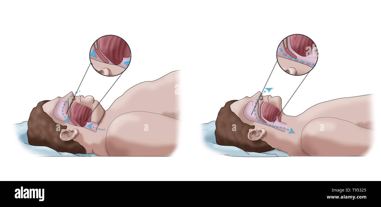 Una illustrazione di un confronto tra un obeso e traversina normale. Negli adulti, apnea nel sonno è comunemente causato da un eccesso di peso e l'obesità. Durante il sonno, quando la gola e la lingua i muscoli sono più rilassati, tessuti molli, eccesso di depositi di grasso e il peso di grasso addominale premendo sui polmoni possono interferire con il normale sonno. Foto Stock