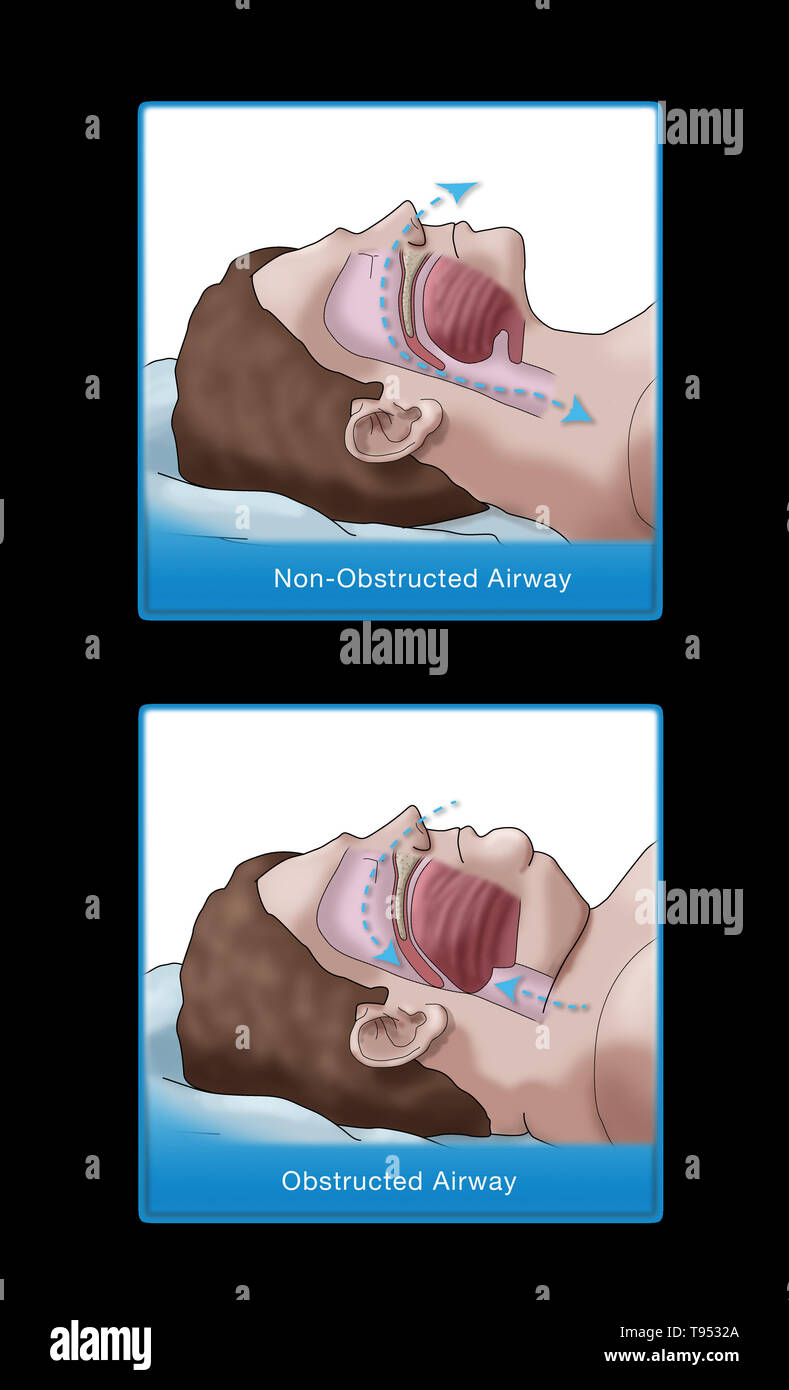 Una illustrazione di un confronto tra un obeso e traversina normale. Negli adulti, apnea nel sonno è comunemente causato da un eccesso di peso e l'obesità. Durante il sonno, quando la gola e la lingua i muscoli sono più rilassati, tessuti molli, eccesso di depositi di grasso e il peso di grasso addominale premendo sui polmoni possono interferire con il normale sonno. Foto Stock