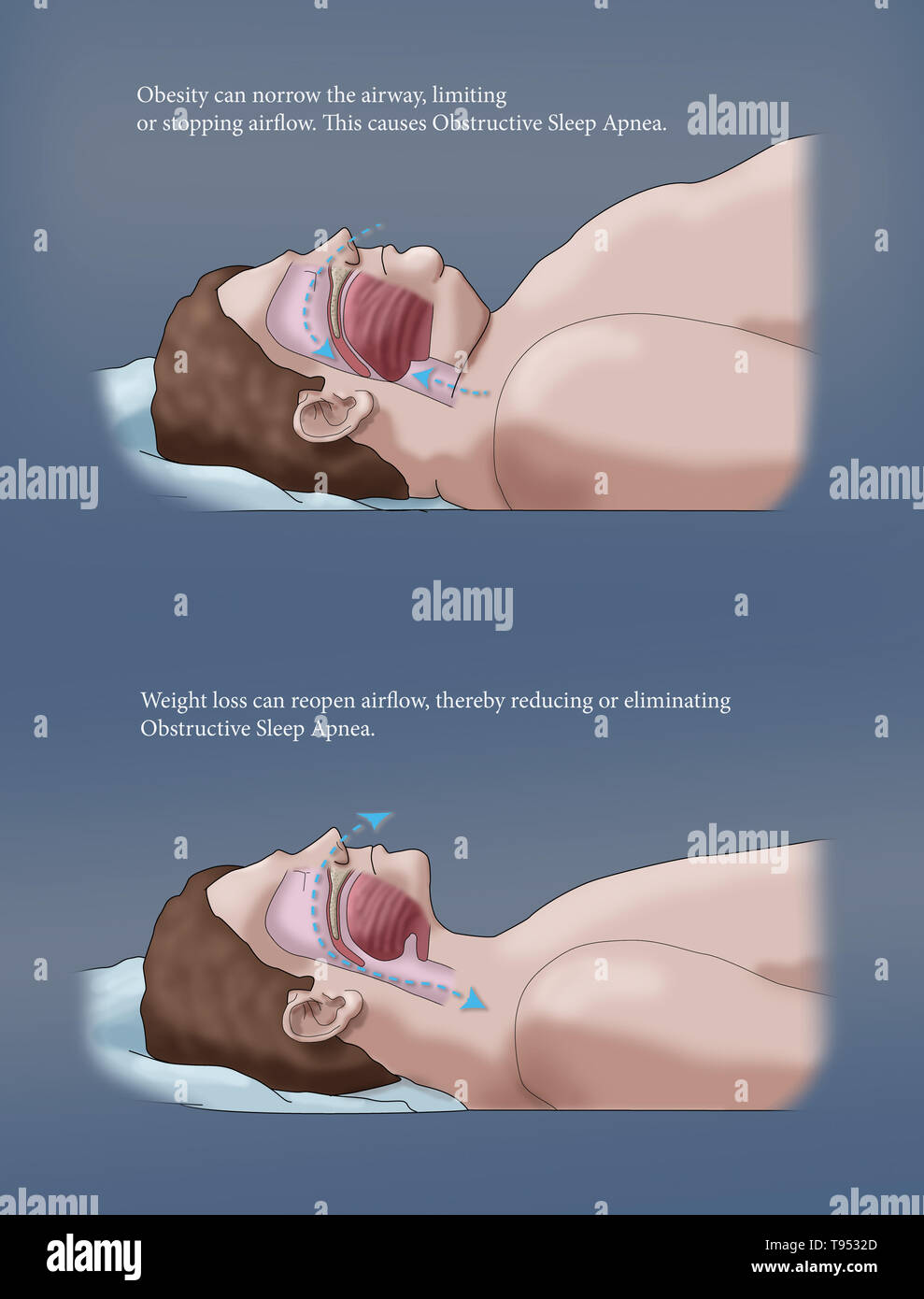 Una illustrazione di un confronto tra un obeso e traversina normale. Negli adulti, apnea nel sonno è comunemente causato da un eccesso di peso e l'obesità. Durante il sonno, quando la gola e la lingua i muscoli sono più rilassati, tessuti molli, eccesso di depositi di grasso e il peso di grasso addominale premendo sui polmoni possono interferire con il normale sonno. Foto Stock