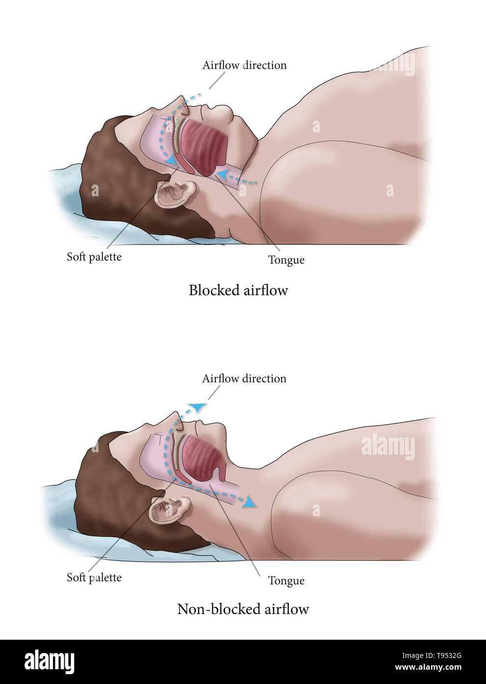 Una illustrazione di un confronto tra un obeso e traversina normale. Negli adulti, apnea nel sonno è comunemente causato da un eccesso di peso e l'obesità. Durante il sonno, quando la gola e la lingua i muscoli sono più rilassati, tessuti molli, eccesso di depositi di grasso e il peso di grasso addominale premendo sui polmoni possono interferire con il normale sonno. Foto Stock