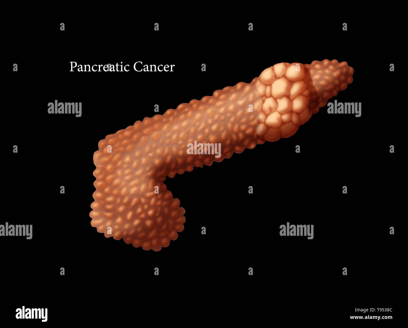 Illustrazione del cancro pancreatico. Foto Stock