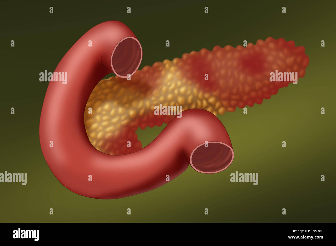 Una illustrazione che mostra un pancreas con pancreatite acuta. La pancreatite è una infiammazione del pancreas. Foto Stock