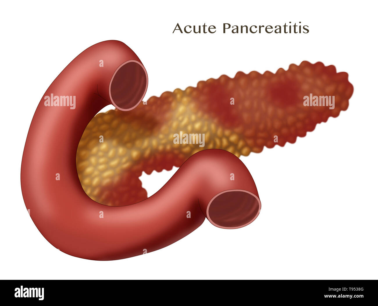 Una illustrazione che mostra un pancreas con pancreatite acuta. La pancreatite è una infiammazione del pancreas. Foto Stock