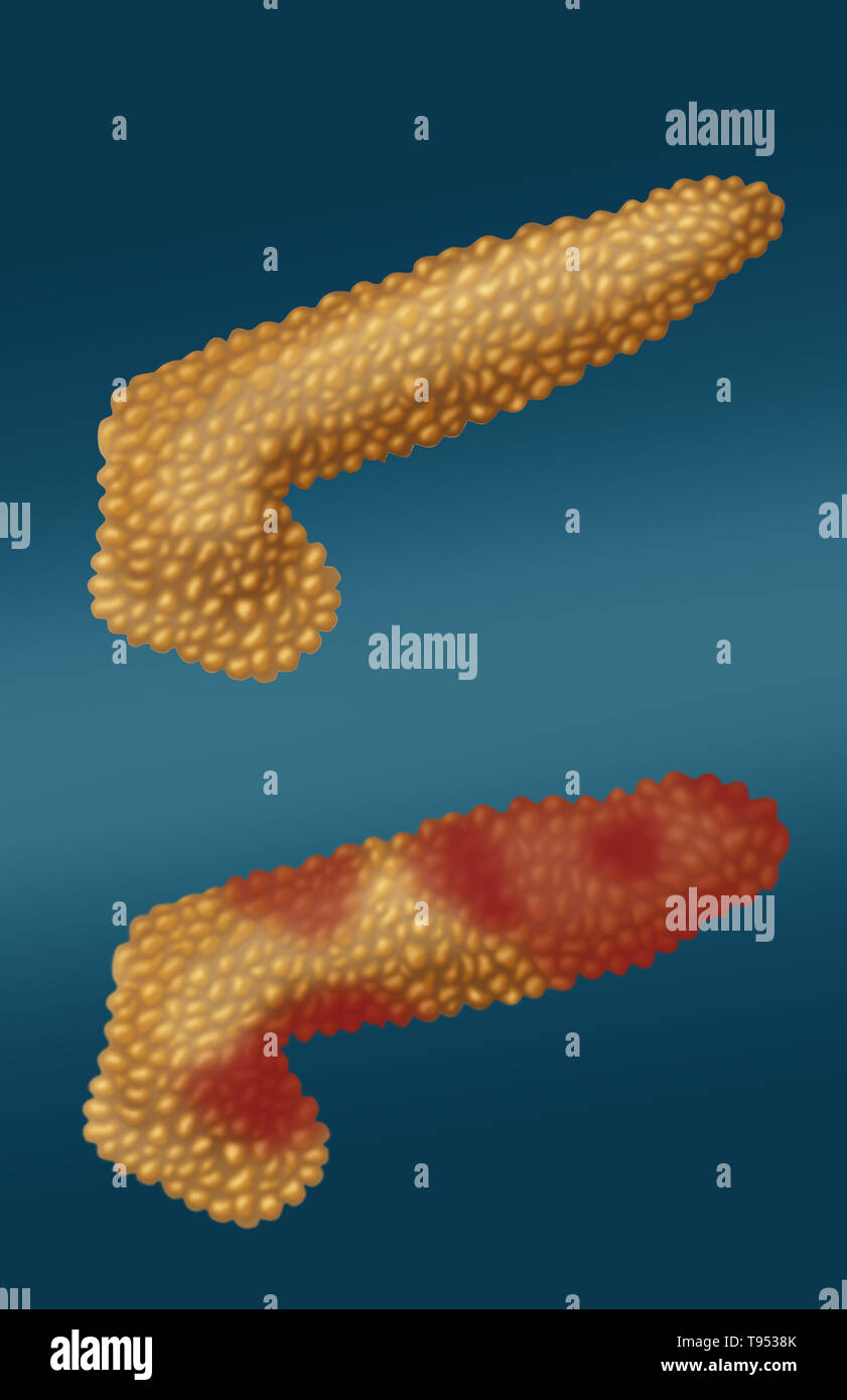 Una illustrazione che mostra un pancreas con pancreatite acuta al di sotto di un pancreas normale. La pancreatite è una infiammazione del pancreas. Foto Stock