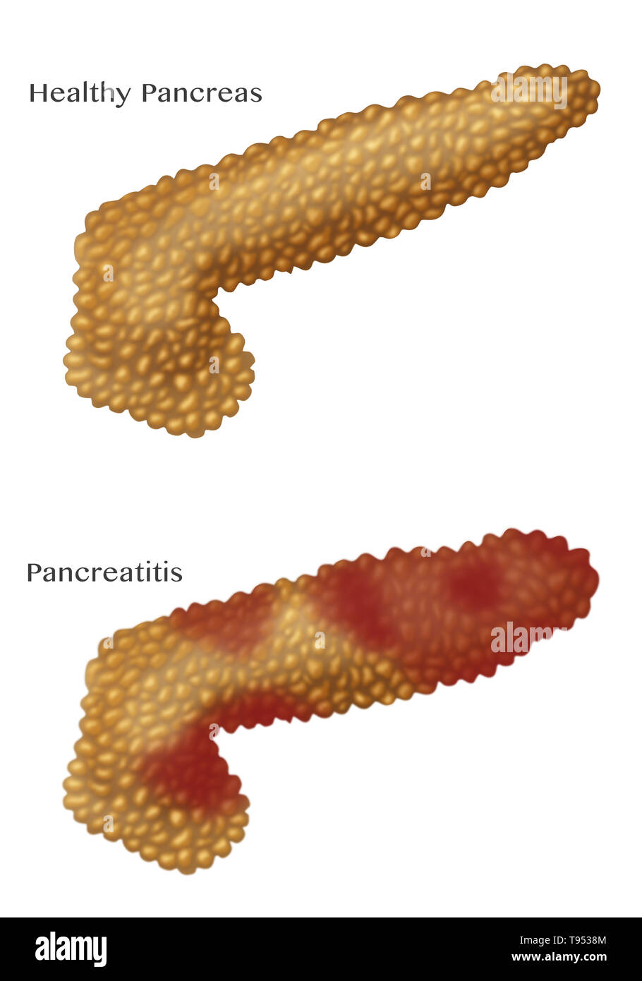 Una illustrazione che mostra un pancreas con pancreatite acuta al di sotto di un pancreas normale. La pancreatite è una infiammazione del pancreas. Foto Stock