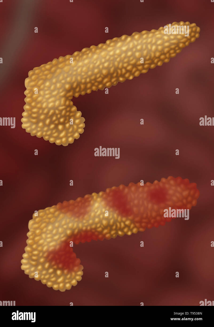 Una illustrazione che mostra un pancreas con pancreatite acuta al di sotto di un pancreas normale. La pancreatite è una infiammazione del pancreas. Foto Stock