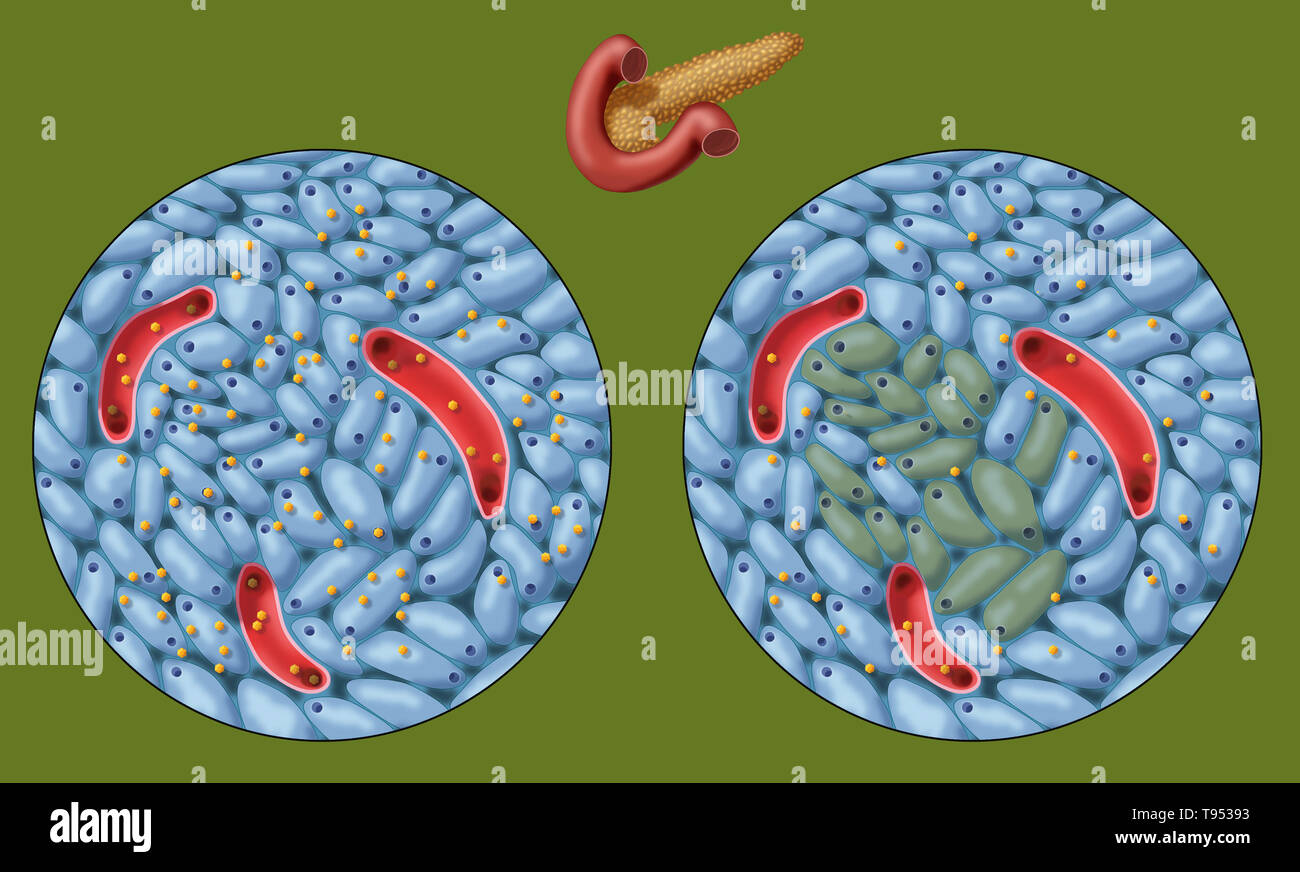 Una illustrazione che mostra il normale (sinistra) e danneggiato le cellule produttrici di insulina (destro) nel diabete di tipo 1. Foto Stock