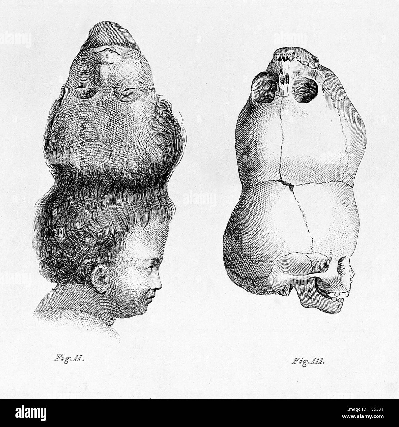 La cosiddetta 'Two-Headed Boy del Bengala' è nato nel 1783 e morto di un cobra morso nel 1787. Il suo cranio rimane nella raccolta della Hunterian Museum of the Royal College of Surgeons di Londra. Craniopagus parasiticus è estremamente raro tipo di gemellaggio parassita che si verificano in circa da 4 a 6 di 10.000.000 di nascite. In craniopagus parasiticus, un parassita testa doppia con un corpo non sviluppata è attaccato alla testa di una sviluppata twin. Foto Stock