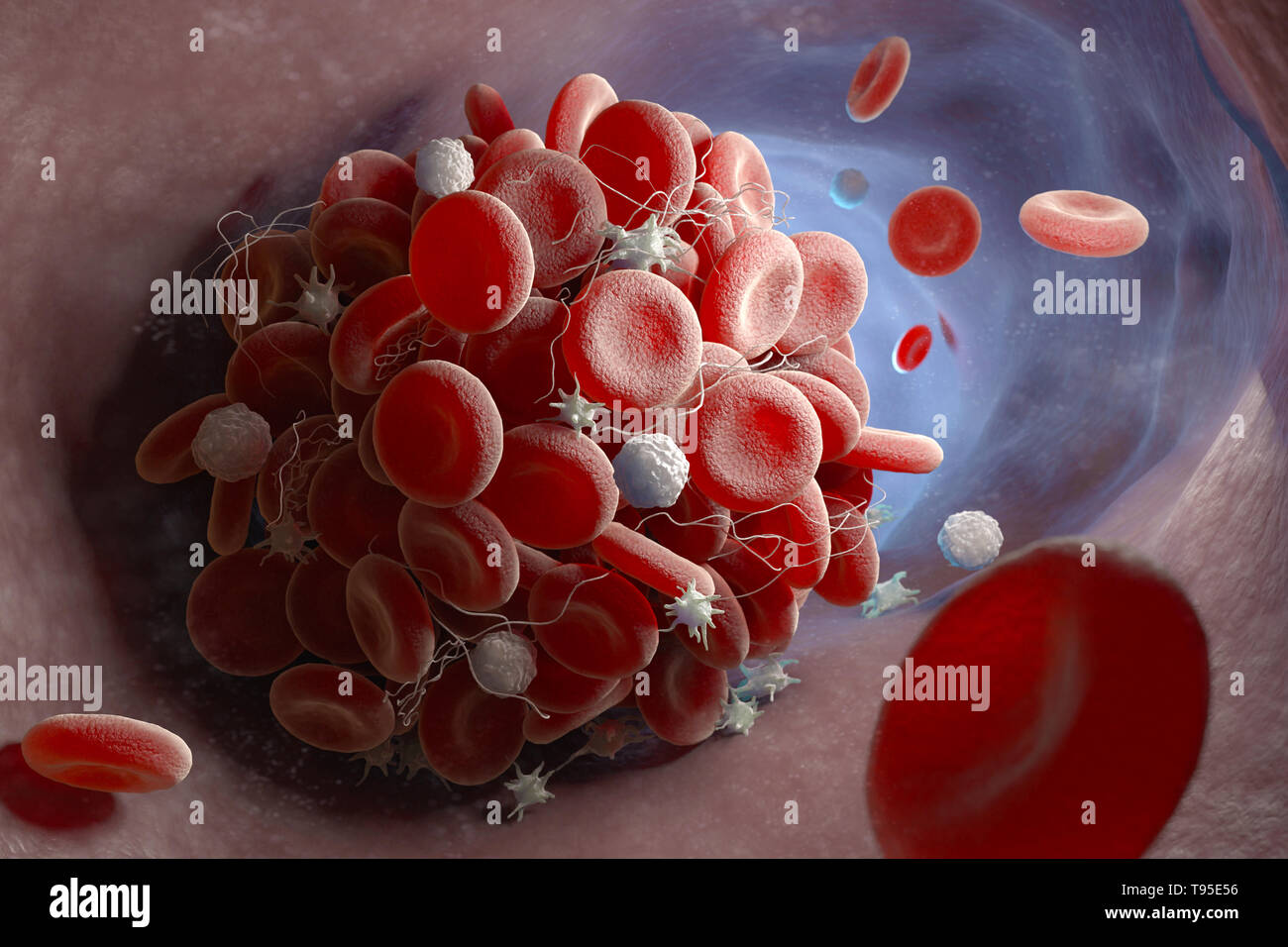 Rappresentazione di un coagulo di sangue formando all'interno di un vaso sanguigno. 3D illustrazione Foto Stock