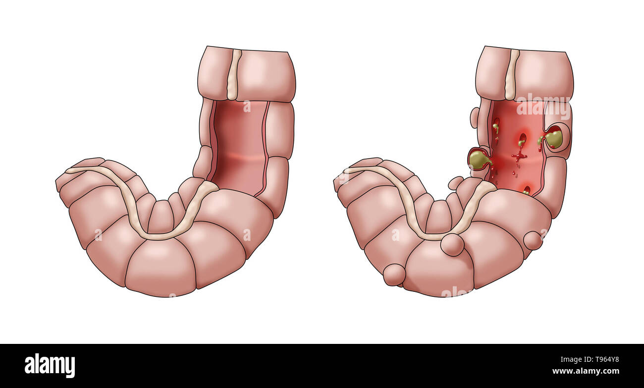 Illustrazione confrontando la comparsa di un sano colon (sinistra) e diverticolite (a destra). Foto Stock
