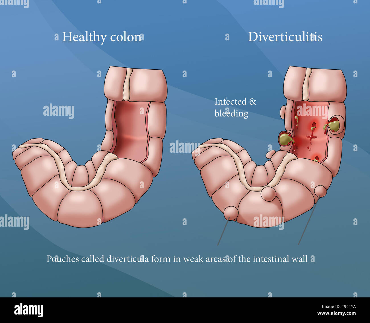 Illustrazione confrontando la comparsa di un sano colon (sinistra) e diverticolite (a destra). Foto Stock