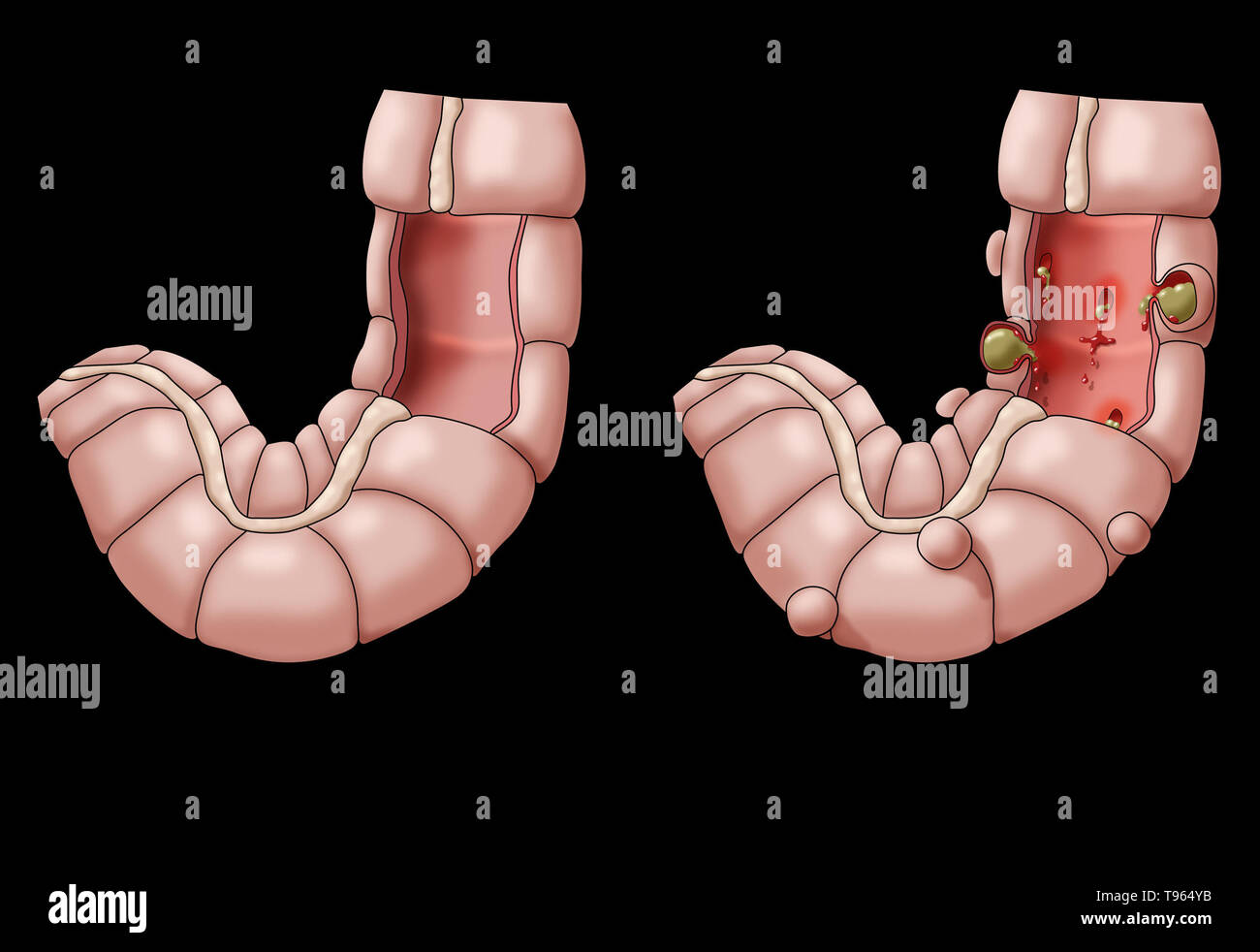 Illustrazione confrontando la comparsa di un sano colon (sinistra) e diverticolite (a destra). Foto Stock