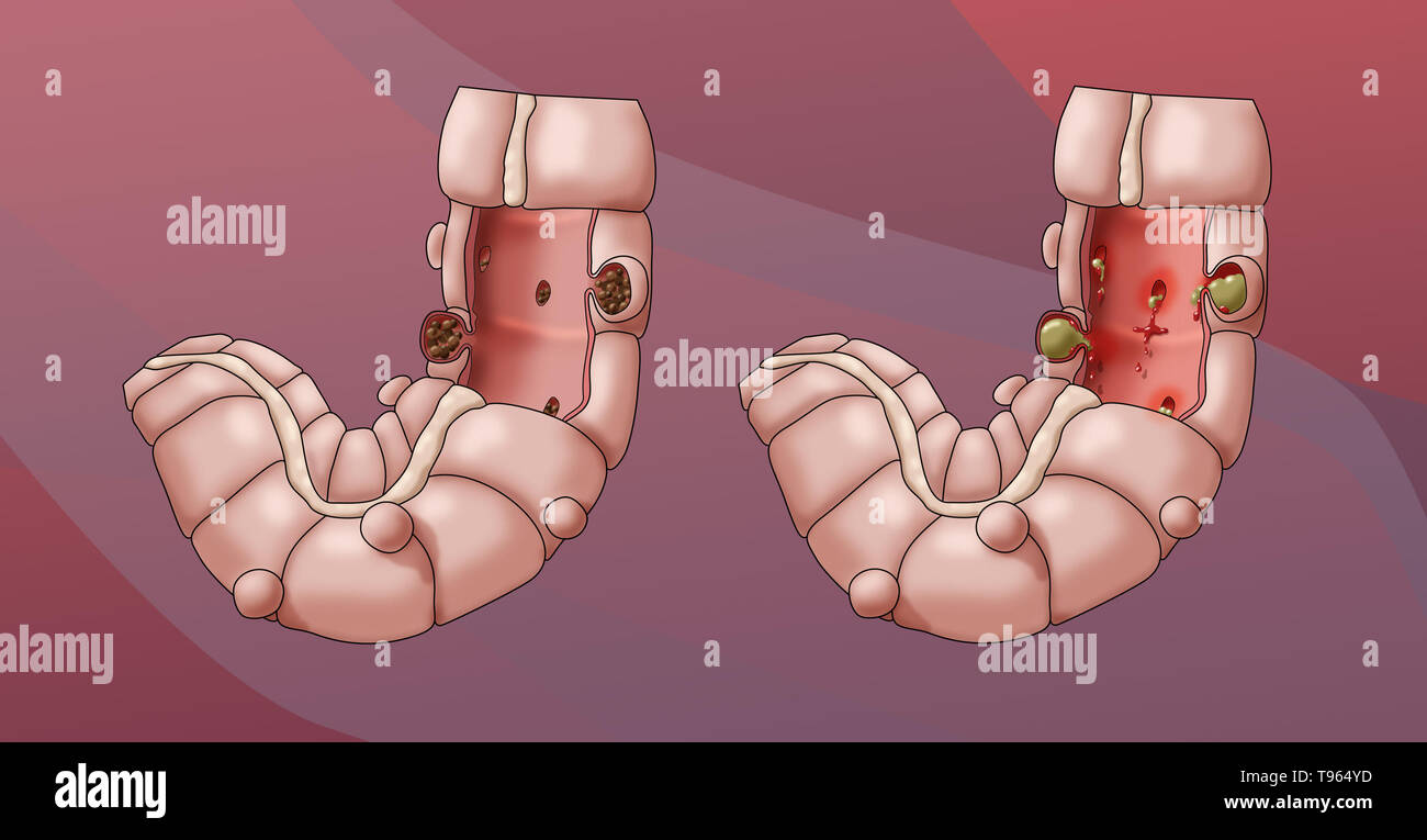 Illustrazione confrontando l'aspetto di un colon con la diverticolosi (sinistra) con diverticolite (a destra). Foto Stock