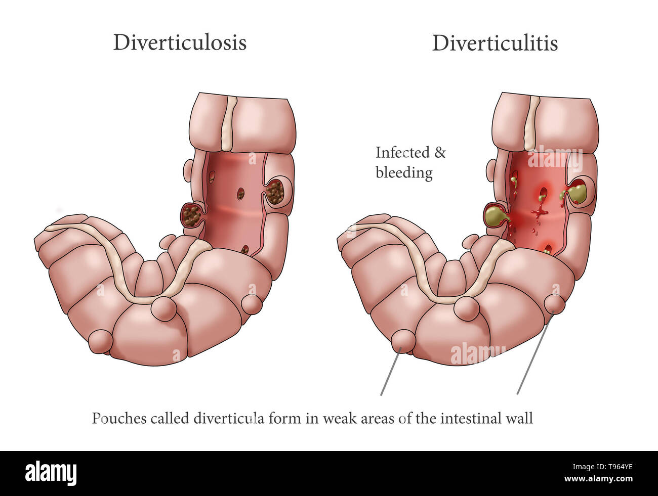 Illustrazione confrontando l'aspetto di un colon con la diverticolosi (sinistra) con diverticolite (a destra). Foto Stock