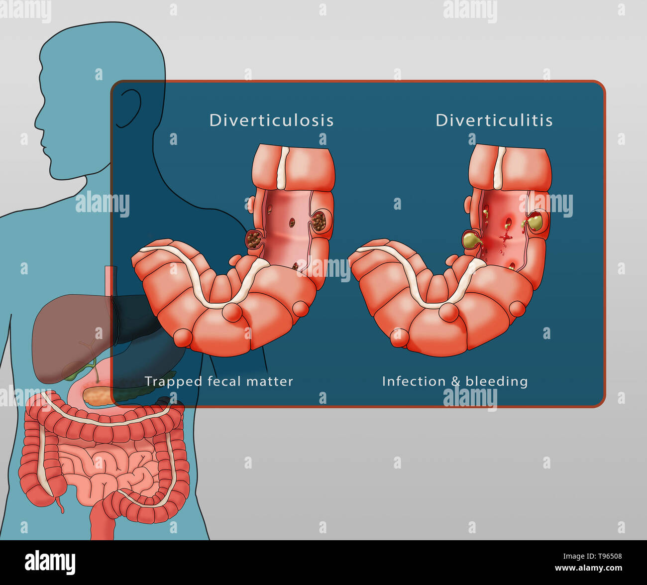 Illustrazione confrontando la comparsa di diverticolosi (sinistra) e diverticolite (destra); un maschio di silhouette con il sistema digestivo è evidenziata in background. Foto Stock