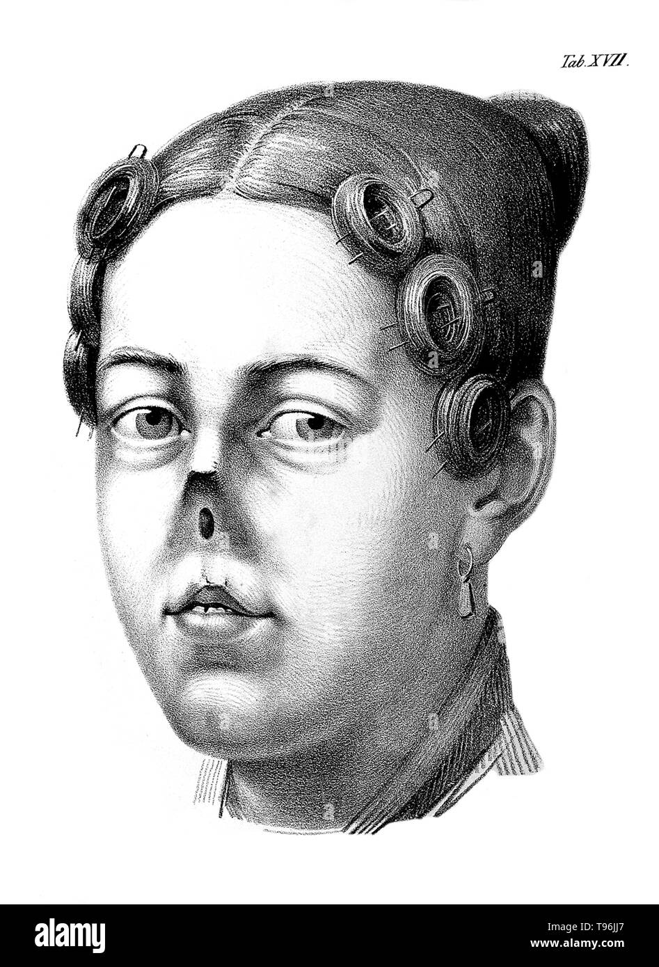 Chirurgische Erfahrungen. Donna con senza naso. Johann Friedrich Dieffenbach (Febbraio 1, 1792 - 11 novembre 1847) era un tedesco che il chirurgo specializzato nel trapianto di pelle e chirurgia plastica. Il suo lavoro in rhinoplastic e chirurgia maxillo-facciale stabilito molte delle moderne tecniche di chirurgia ricostruttiva. Prima della scoperta della tipizzazione del sangue e il sangue matching, Dieffenbach ricercato la trasfusione di sangue. Foto Stock