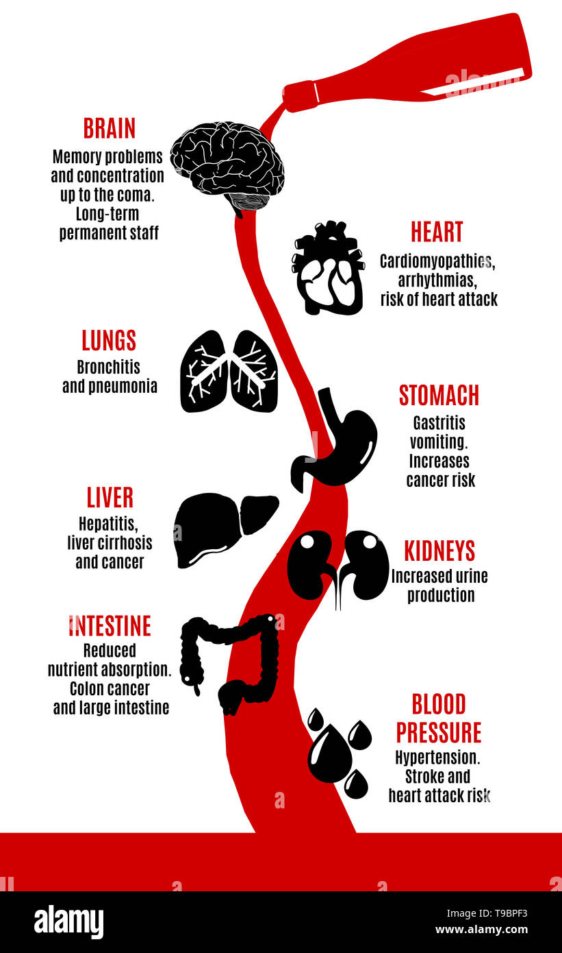 Illustrazione di alcol effetti collaterali sul cervello umano, del cuore, del fegato, dello stomaco e dell'intestino Foto Stock