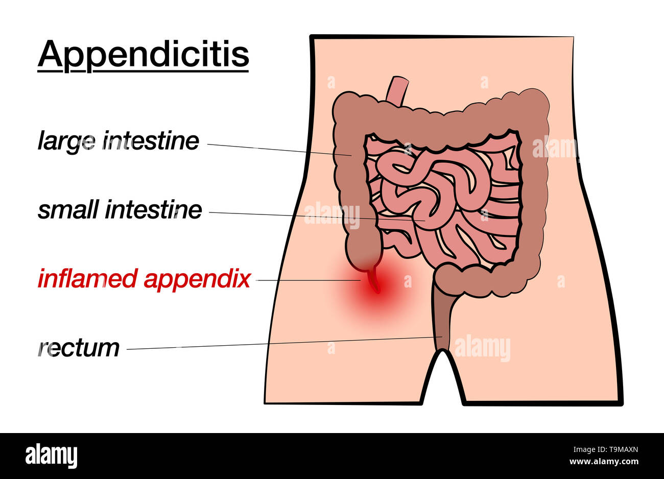 Appendicite. Appendice infiammata. Grafico marcato con il grande e il piccolo intestino, appendice e retto su sfondo bianco. Foto Stock