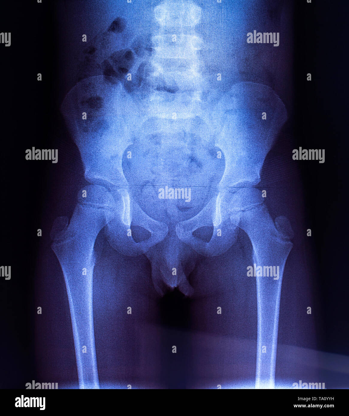 X-ray delle ossa pelviche del bambino Foto Stock