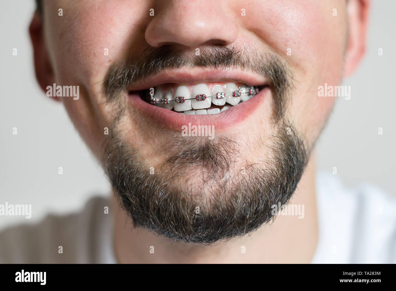 Close up di un giovane uomo con bretelle sorridente. Ripresa macro di un giovane uomo con rinforzi su uno sfondo bianco. Foto Stock