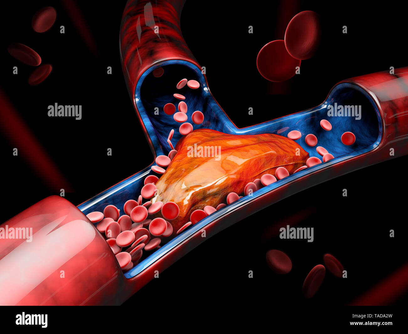 3d illustrazione di trombosi venosa profonda o coaguli di sangue. Embolia. Foto Stock