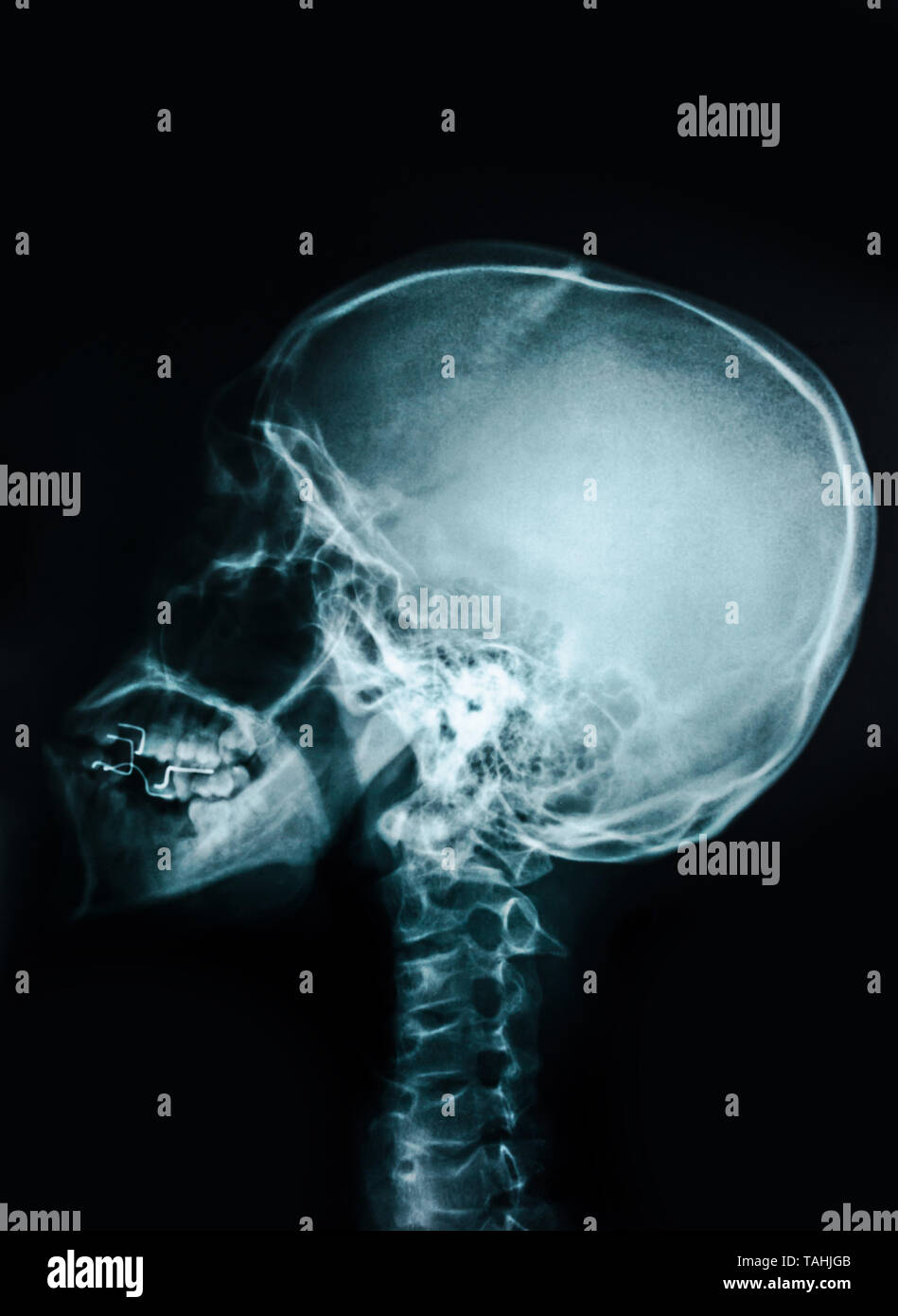 Film x-ray del cranio e della colonna vertebrale cervicale vista laterale Foto Stock