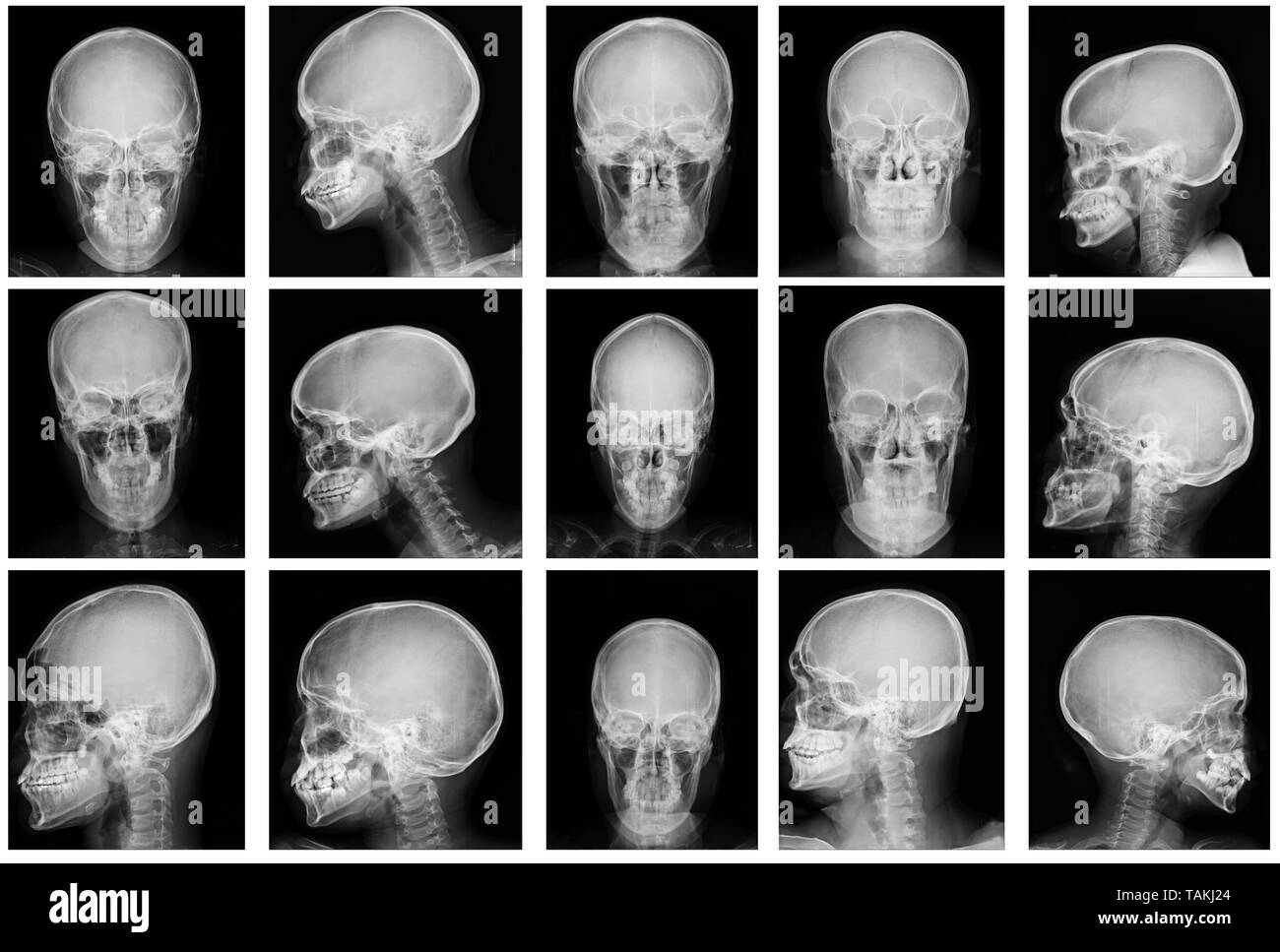 Cranio di raccolta x-ray immagine in toni di grigio Foto Stock