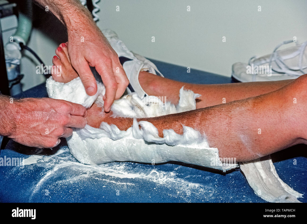 Un medico ortopedico tira fuori la fodera protettiva in cotone all'interno del gesso che sosteneva la caviglia rotta di una donna caucasica mentre l'osso fratturato nella gamba sinistra stava curando. Inizialmente, l'intonaco era perforato con una speciale sega a getto elettrica con una lama oscillante che vibra invece di girare, impedendo così il taglio della pelle. La sega oscillante è stata brevettata per uso medico nel 1945 da un chirurgo ortopedico americano, Dr. Homer Stryker, ed è ancora la sega da taglio più comune in uso oggi. Foto Stock