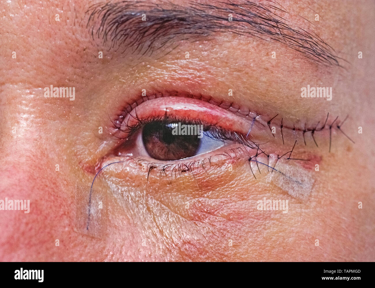Un close-up dell'occhio sinistro di una donna caucasica dopo cosmetic blefaroplastica mostra la multa punti usati per evitare di mostrare le cicatrici da incisioni di sutura con ago e filo. Chiamato anche della blefaroplastica, occhio sollevare la chirurgia può rimuovere la pelle in eccesso dalle palpebre superiori (che possono ostacolare la visione) e ridurre bagginess da palpebre inferiori. La procedura è una scelta popolare per Facciale Chirurgia plastica quando la pelle perde la sua elasticità come una persona matura. Foto Stock