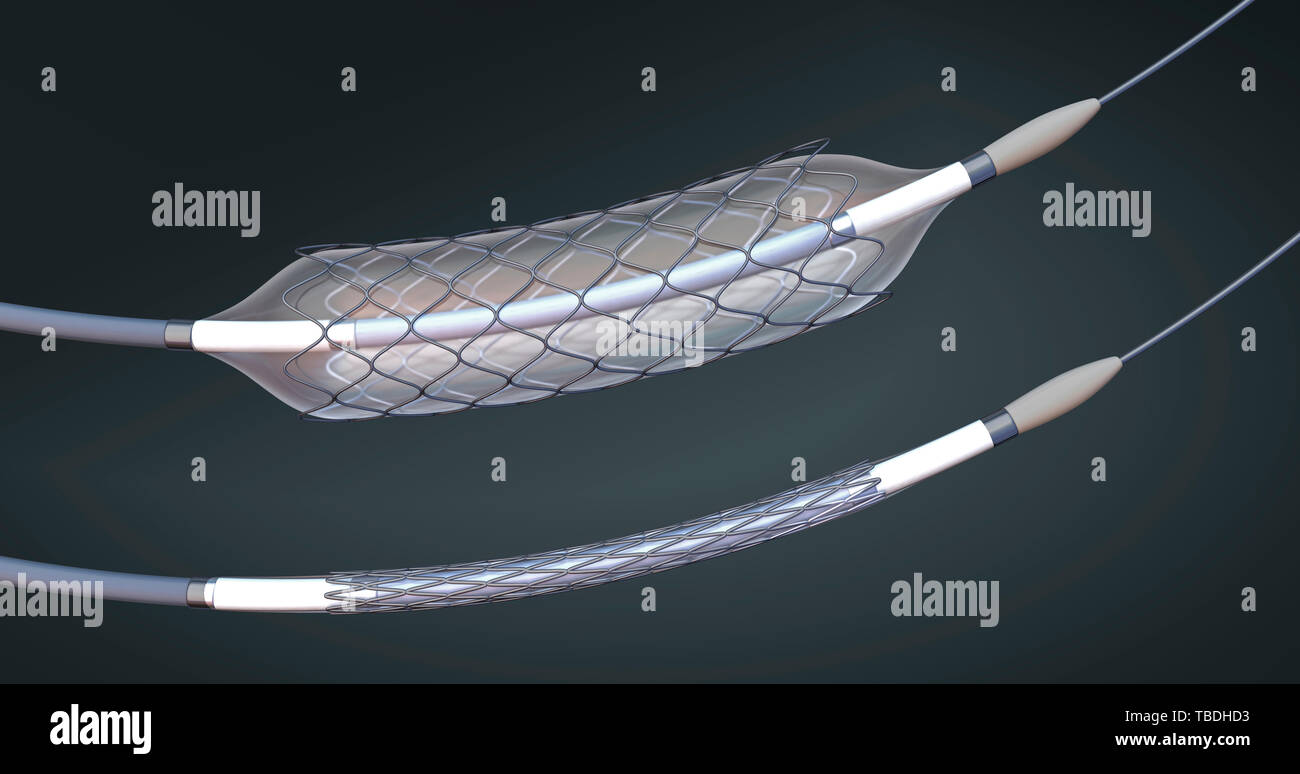 Sgonfiato e gonfiato a stent e cateteri a palloncino, illustrazione. Foto Stock