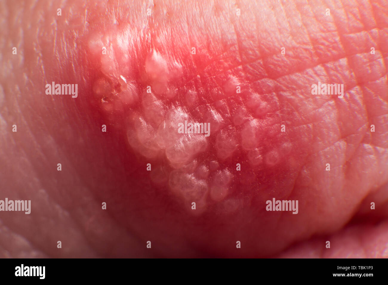 Inizio della coltivazione di herpes su caucasica uomo maschio sul lato anteriore di un labbro superiore super macro closeup. micro Foto Stock