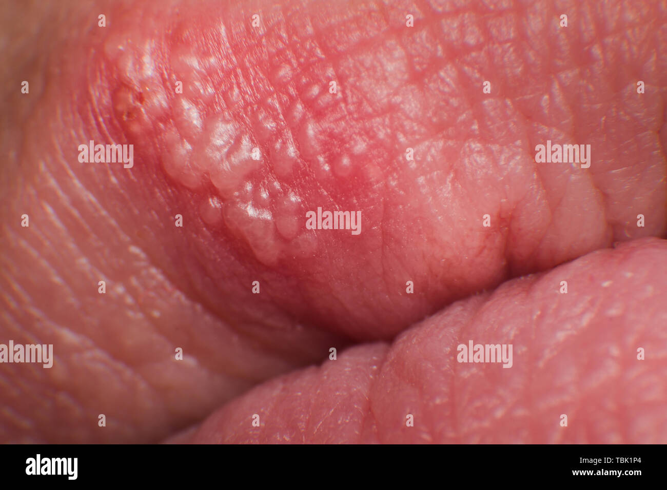 Inizio della coltivazione di herpes su caucasica uomo maschio sul lato anteriore di un labbro superiore super macro closeup. micro Foto Stock