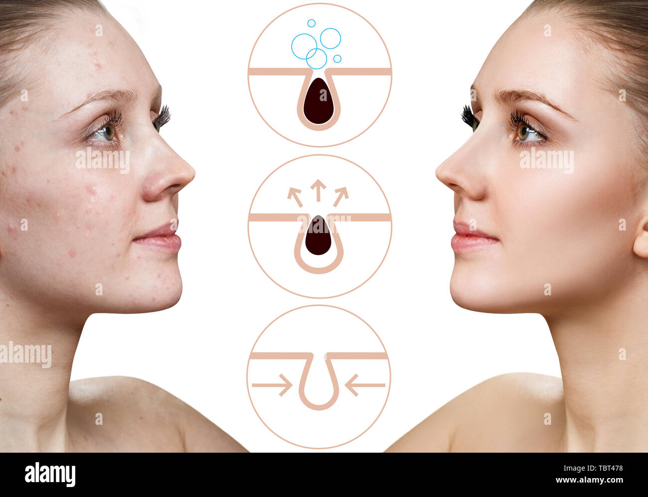 La donna mostra come inquinare e pulire i pori sulla faccia. Foto Stock
