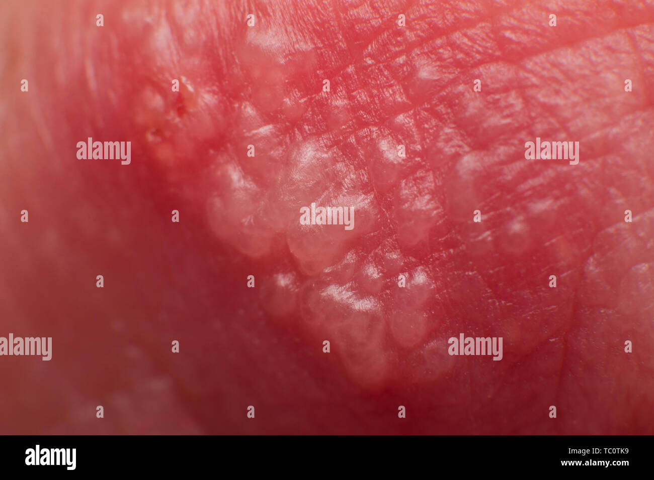 Inizio della coltivazione di herpes su caucasica uomo maschio sul lato anteriore di un labbro superiore super microscopio macro Foto Stock