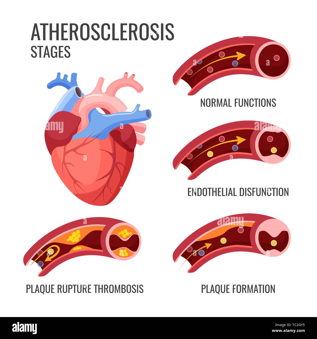 Stadi di aterosclerosi. Le normali funzioni, la disfunzione endothelia, formazione della placca rottura della placca trombosi. Arteriosclerotica malattia vascolare o come Illustrazione Vettoriale