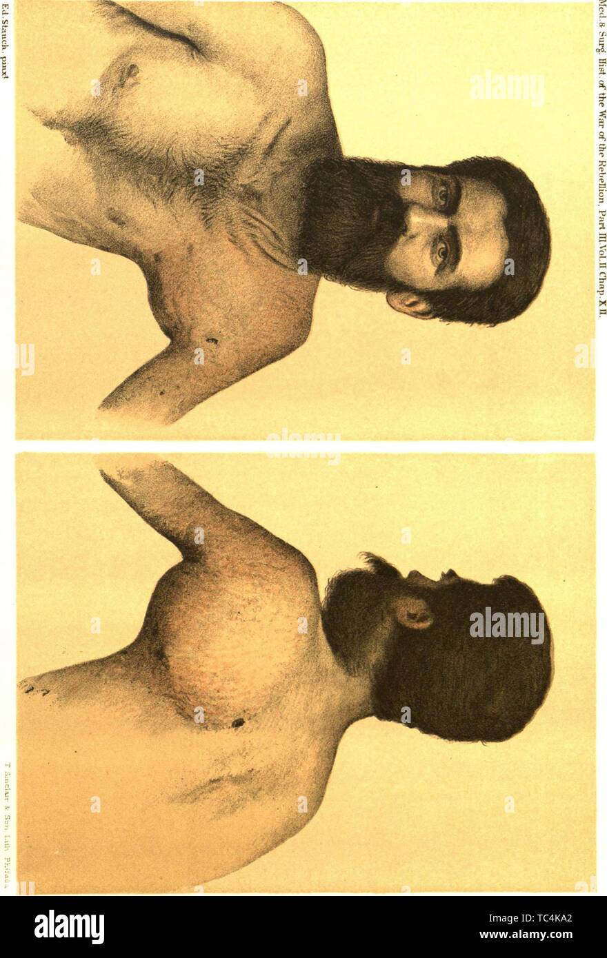 Incisioni di un aneurisma traumatico, dal libro "L'anamnesi medica e chirurgica della guerra della ribellione" DA PARTE DEGLI STATI UNITI Esercito Chirurgo generale Ufficio, 1883. La cortesia Internet Archive. () Foto Stock